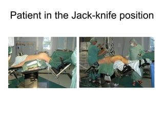 Patient in the Jack-knife position 