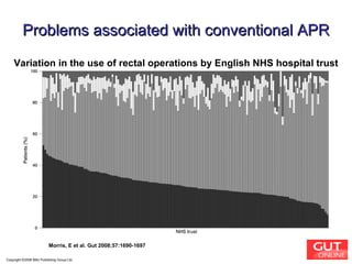 Copyright ©2008 BMJ Publishing Group Ltd. Morris, E et al. Gut 2008;57:1690-1697 Problems associated with conventional APR Variation in the use of rectal operations by English NHS hospital trust 