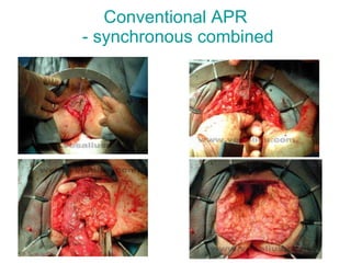 Conventional APR  - synchronous combined 