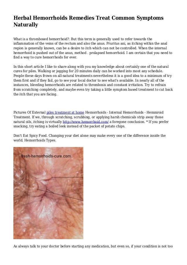 herbal hemorrhoids remedies treat common symptoms naturally symptoms of hemroids