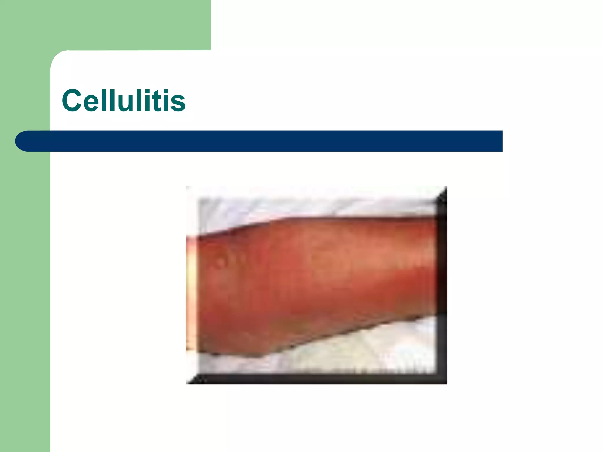 Cellulitis
 