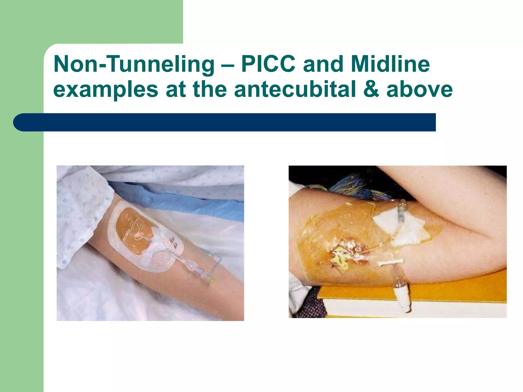 Non-Tunneling – PICC and Midline
examples at the antecubital & above
 