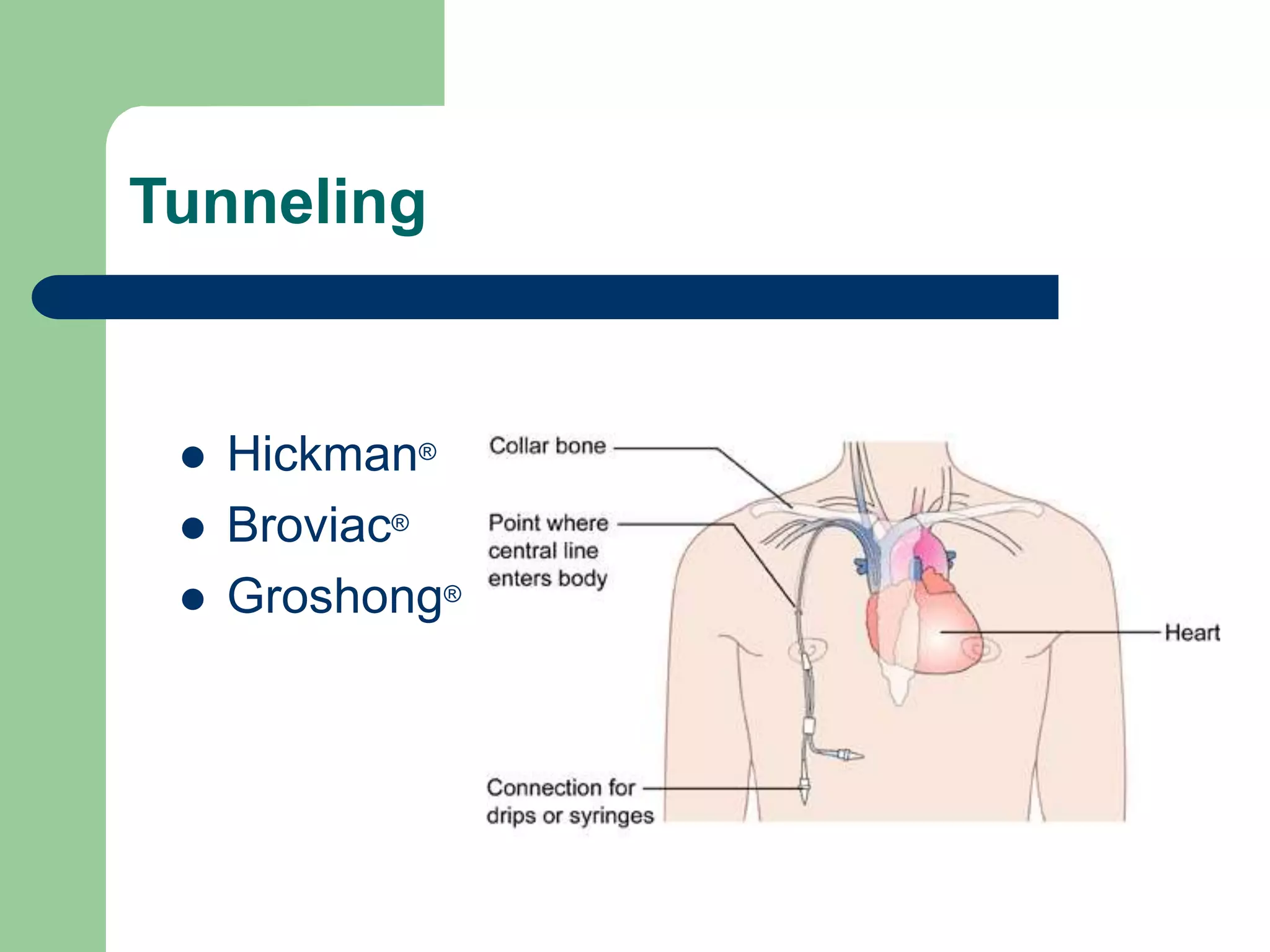 Tunneling
 Hickman®
 Broviac®
 Groshong®
 