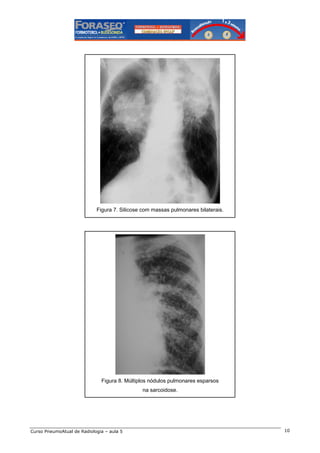 Figura 7. Silicose com massas pulmonares bilaterais.

Figura 8. Múltiplos nódulos pulmonares esparsos
na sarcoidose.

Curso PneumoAtual de Radiologia – aula 5

10

 