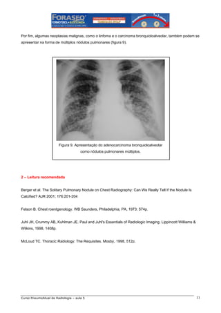 Por fim, algumas neoplasias malignas, como o linfoma e o carcinoma bronquioloalveolar, também podem se
apresentar na forma de múltiplos nódulos pulmonares (figura 9).

Figura 9. Apresentação do adenocarcinoma bronquioloalveolar
como nódulos pulmonares múltiplos.

2 – Leitura recomendada

Berger et al. The Solitary Pulmonary Nodule on Chest Radiography: Can We Really Tell If the Nodule Is
Calcified? AJR 2001; 176:201-204

Felson B. Chest roentgenology. WB Saunders, Philadelphia, PA, 1973: 574p.

Juhl JH, Crummy AB, Kuhlman JE. Paul and Juhl's Essentials of Radiologic Imaging. Lippincott Williams &
Wilkins, 1998, 1408p.

McLoud TC. Thoracic Radiology: The Requisites. Mosby, 1998, 512p.

Curso PneumoAtual de Radiologia – aula 5

11

 