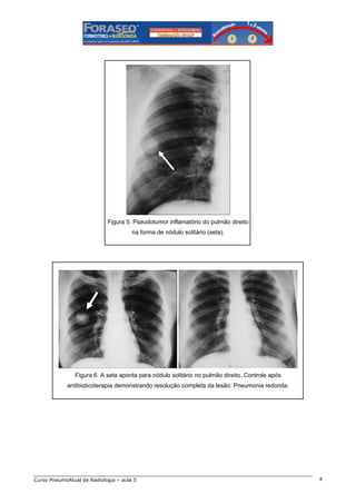 Figura 5. Pseudotumor inflamatório do pulmão direito
na forma de nódulo solitário (seta).

Figura 6. A seta aponta para nódulo solitário no pulmão direito. Controle após
antibioticoterapia demonstrando resolução completa da lesão. Pneumonia redonda.

Curso PneumoAtual de Radiologia – aula 5

4

 