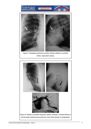 Figura 7. Neoplasia pulmonar primária. Nódulo solitário no pulmão
direito, espiculado (setas).

Figura 8. Nódulo no pulmão esquerdo (setas), lobulado, correspondendo a
má formação arteriovenosa pulmonar, bem demonstrada na angiografia.

Curso PneumoAtual de Radiologia – aula 5

5

 