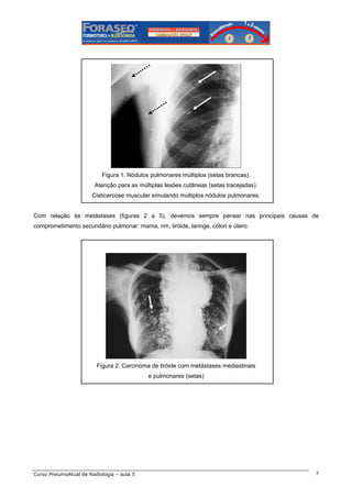 Figura 1. Nódulos pulmonares múltiplos (setas brancas).
Atenção para as múltiplas lesões cutâneas (setas tracejadas).
Cisticercose muscular simulando múltiplos nódulos pulmonares.

Com relação às metástases (figuras 2 a 5), devemos sempre pensar nas principais causas de
comprometimento secundário pulmonar: mama, rim, tiróide, laringe, cólon e útero.

Figura 2. Carcinoma de tiróide com metástases mediastinais
e pulmonares (setas)

Curso PneumoAtual de Radiologia – aula 5

7

 