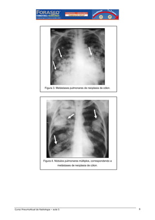 Figura 3. Metástases pulmonares de neoplasia de cólon.

Figura 4. Nódulos pulmonares múltiplos, correspondendo a
metástases de neoplasia de cólon.

Curso PneumoAtual de Radiologia – aula 5

8

 