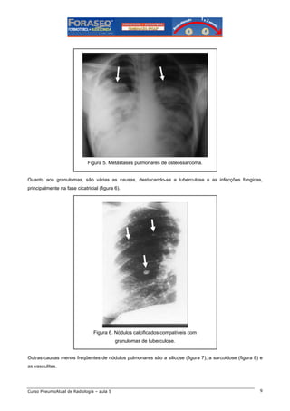 Figura 5. Metástases pulmonares de osteossarcoma.

Quanto aos granulomas, são várias as causas, destacando-se a tuberculose e as infecções fúngicas,
principalmente na fase cicatricial (figura 6).

Figura 6. Nódulos calcificados compatíveis com
granulomas de tuberculose.

Outras causas menos freqüentes de nódulos pulmonares são a silicose (figura 7), a sarcoidose (figura 8) e
as vasculites.

Curso PneumoAtual de Radiologia – aula 5

9

 