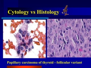 Cytology vs Histology
Papillary carcinoma of thyroid - follicular variant
 