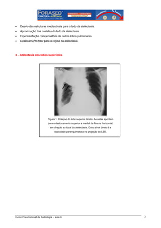 •

Desvio das estruturas mediastinais para o lado da atelectasia.

•

Aproximação das costelas do lado da atelectasia.

•

Hiperinsuflação compensatória de outros lobos pulmonares.

•

Deslocamento hilar para a região da atelectasia.

4 – Atelectasia dos lobos superiores

Figura 1. Colapso do lobo superior direito. As setas apontam
para o deslocamento superior e medial da fissura horizontal,
em direção ao local da atelectasia. Outro sinal direto é a
opacidade parenquimatosa na projeção do LSD.

Curso PneumoAtual de Radiologia – aula 6

2

 