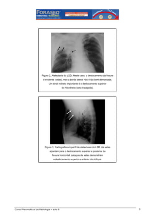 Figura 2. Atelectasia do LSD. Neste caso, o deslocamento da fissura
é evidente (setas), mas a borda lateral não é tão bem demarcada.
Um sinal indireto importante é o deslocamento superior
do hilo direito (seta tracejada).

Figura 3. Radiografia em perfil de atelectasia do LSD. As setas
apontam para o deslocamento superior e posterior da
fissura horizontal; cabeças de setas demonstram
o deslocamento superior e anterior da oblíqua.

Curso PneumoAtual de Radiologia – aula 6

3

 