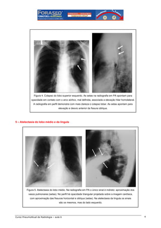 Figura 4. Colapso do lobo superior esquerdo. As setas na radiografia em PA apontam para
opacidade em contato com o arco aórtico, mal definida, associada a elevação hilar homolateral.
A radiografia em perfil demonstra com mais clareza o colapso lobar. As setas apontam para
elevação e desvio anterior da fissura oblíqua.

5 – Atelectasia do lobo médio e da língula

Figura 5. Atelectasia do lobo médio. Na radiografia em PA o único sinal é indireto: aproximação dos
vasos pulmonares (setas). No perfil há opacidade triangular projetada sobre a imagem cardíaca,
com aproximação das fissuras horizontal e oblíqua (setas). Na atelectasia da língula os sinais
são os mesmos, mas do lado esquerdo.

Curso PneumoAtual de Radiologia – aula 6

4

 