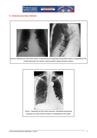 6 – Atelectasia dos lobos inferiores

Figura 6. Atelectasia do lobo inferior direito. A seta aponta para opacidade paracardíaca direita na radiografia em PA.
O perfil demonstra com clareza o desvio posterior (setas) da fissura oblíqua.

Figura 7. Atelectasia do lobo inferior esquerdo. Opacidade paracardíaca
esquerda com duplo contorno cardíaco na radiografia em PA (setas).

Curso PneumoAtual de Radiologia – aula 6

5

 