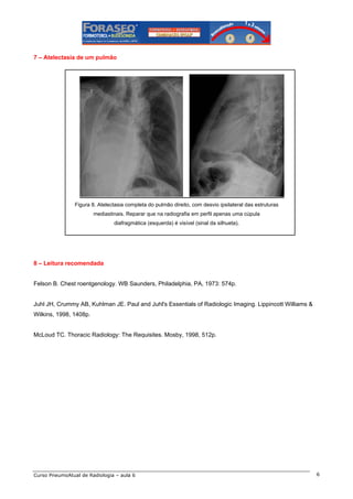 7 – Atelectasia de um pulmão

Figura 8. Atelectasia completa do pulmão direito, com desvio ipsilateral das estruturas
mediastinais. Reparar que na radiografia em perfil apenas uma cúpula
diafragmática (esquerda) é visível (sinal da silhueta).

8 – Leitura recomendada

Felson B. Chest roentgenology. WB Saunders, Philadelphia, PA, 1973: 574p.

Juhl JH, Crummy AB, Kuhlman JE. Paul and Juhl's Essentials of Radiologic Imaging. Lippincott Williams &
Wilkins, 1998, 1408p.

McLoud TC. Thoracic Radiology: The Requisites. Mosby, 1998, 512p.

Curso PneumoAtual de Radiologia – aula 6

6

 