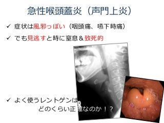  症状は風邪っぽい（咽頭痛、嚥下時痛）
 でも見逃すと時に窒息＆致死的
 よく使うレントゲンは
どのくらい正確なのか！？
急性喉頭蓋炎（声門上炎）
 