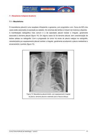7 – Neoplasias malignas da pleura

7.1 – Mesotelioma

O mesotelioma pleural é uma neoplasia infreqüente e agressiva, com prognóstico ruim. Cerca de 80% dos
casos estão associados à exposição ao asbesto. Os sintomas são tardios e incluem dor torácica e dispnéia.
A manifestação radiográfica mais comum é a de opacidade pleural nodular e irregular, geralmente
associada a derrame pleural (figura 14). Em alguns casos só há derrame pleural, sem caracterização de
lesões sólidas na radiografia. Com a progressão do tumor há sinais de pleura maligna na radiografia,
caracterizados por espessamento pleural nodular e irregular, geralmente envolvendo a pleura mediastinal e
encarcerando o pulmão (figura 15).

Figura 14. Mesotelioma pleural direito, com espessamento irregular
da pleura, derrame pleural e extensão para a fissura oblíqua.

Curso PneumoAtual de Radiologia – aula 8

10

 