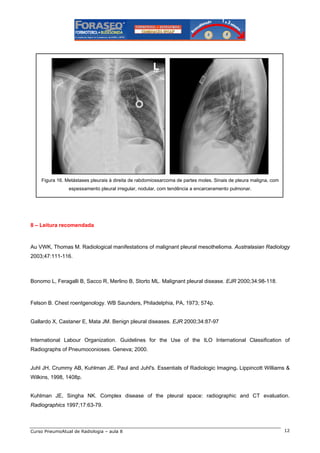 Figura 16. Metástases pleurais à direita de rabdomiossarcoma de partes moles. Sinais de pleura maligna, com
espessamento pleural irregular, nodular, com tendência a encarceramento pulmonar.

8 – Leitura recomendada

Au VWK, Thomas M. Radiological manifestations of malignant pleural mesothelioma. Australasian Radiology
2003;47:111-116.

Bonomo L, Feragalli B, Sacco R, Merlino B, Storto ML. Malignant pleural disease. EJR 2000;34:98-118.

Felson B. Chest roentgenology. WB Saunders, Philadelphia, PA, 1973; 574p.

Gallardo X, Castaner E, Mata JM. Benign pleural diseases. EJR 2000;34:87-97

International Labour Organization. Guidelines for the Use of the ILO International Classification of
Radiographs of Pneumoconioses. Geneva; 2000.

Juhl JH, Crummy AB, Kuhlman JE. Paul and Juhl's. Essentials of Radiologic Imaging. Lippincott Williams &
Wilkins, 1998, 1408p.

Kuhlman JE, Singha NK. Complex disease of the pleural space: radiographic and CT evaluation.
Radiographics 1997;17:63-79.

Curso PneumoAtual de Radiologia – aula 8

12

 