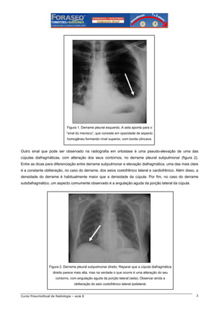 Figura 1. Derrame pleural esquerdo. A seta aponta para o
“sinal do menisco”, que consiste em opacidade de aspecto
homogêneo formando nível superior, com borda côncava.

Outro sinal que pode ser observado na radiografia em ortostase é uma pseudo-elevação de uma das
cúpulas diafragmáticas, com alteração dos seus contornos, no derrame pleural subpulmonar (figura 2).
Entre as dicas para diferenciação entre derrame subpulmonar e elevação diafragmática, uma das mais úteis
é a constante obliteração, no caso do derrame, dos seios costofrênico lateral e cardiofrênico. Além disso, a
densidade do derrame é habitualmente maior que a densidade da cúpula. Por fim, no caso do derrame
subdiafragmático, um aspecto comumente observado é a angulação aguda da porção lateral da cúpula.

Figura 2. Derrame pleural subpulmonar direito. Reparar que a cúpula diafragmática
direita parece mais alta, mas na verdade o que ocorre é uma alteração do seu
contorno, com angulação aguda da porção lateral (seta). Observar ainda a
obliteração do seio costofrênico lateral ipsilateral.

Curso PneumoAtual de Radiologia – aula 8

2

 