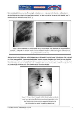 Nos casos de dúvida, como na diferenciação entre derrame e espessamento pleural, a radiografia em
decúbito lateral com raios horizontais (Hjelm-Laurell), do lado do possível derrame, pode auxiliar, pois o
derrame escorre, formando nível (figura 3).

Figura 3. Possível derrame ou espessamento pleural do lado direito, com obliteração do seio costofrênico
ipsilateral. A radiografia em decúbito lateral com raios horizontais mostra opacidade homogênea formando nível,
compatível com derrame pleural.

Nos derrames volumosos pode haver deslocamento contralateral das estruturas mediastinais e/ou inversão
da cúpula diafragmática. Alguns derrames podem assumir aspecto complexo, por vezes loculado (figura 4).
Nestes casos, o conhecimento da história clínica e o acompanhamento da imagem suspeita podem auxiliar
na diferenciação entre derrame pleural e alterações parenquimatosas.

Figura 4. Derrame pleural loculado do lado direito (setas), simulando
massa parenquimatosa. Contudo, a opacidade ultrapassa os limites
das fissuras e tem contornos lisos, aspectos habitualmente
não encontrados em lesões do parênquima pulmonar.
Curso PneumoAtual de Radiologia – aula 8

3

 