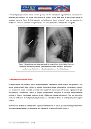 Formas atípicas de derrame pleural ocorrem quando este fica coletado em alguma fissura, simulando uma
consolidação pulmonar, por vezes com aspecto de massa, o que pode levar a falsos diagnósticos de
neoplasia pulmonar (figura 5). Este aspecto, conhecido como “tumor fantasma”, pode ser resolvido com
incidências adicionais, controles radiográficos ou, nos casos de dúvida, auxilio da ultra-sonografia.

Figura 5. Opacidade arredondada na projeção do campo inferior direito (setas). A primeira
hipótese foi a de massa pulmonar, possivelmente de origem neoplásica. A realização
da ultra-sonografia confirmou o diagnóstico de derrame pleural intrafissural.

3 – Espessamento pleural difuso

O espessamento pleural difuso resulta de espessamento e fibrose da pleura visceral, com posterior fusão
com a pleura parietal. Muito comum na seqüela do derrame pleural relacionado à exposição ao asbesto,
não é específico a esta condição, podendo estar relacionado a processos infecciosos, especialmente por
micobactérias, colagenoses, reação a drogas, procedimentos cirúrgicos ou traumas. Ocasionalmente
envolve as fissuras interlobares, podendo simular nódulos ou massas pulmonares. Pode ser decorrente,
ainda, da confluência de múltiplas placas pleurais ou de extensão da fibrose do parênquima pulmonar para
a pleura.

Na radiografia de tórax é definido como espessamento contínuo da pleura, que se estende por no mínimo
um quarto da parede torácica, geralmente com obliteração do seio costofrênico (figura 6).

Curso PneumoAtual de Radiologia – aula 8

4

 