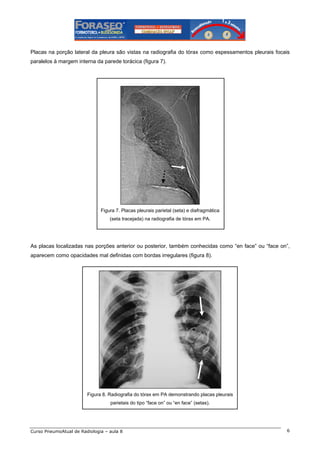 Placas na porção lateral da pleura são vistas na radiografia do tórax como espessamentos pleurais focais
paralelos à margem interna da parede torácica (figura 7).

Figura 7. Placas pleurais parietal (seta) e diafragmática
(seta tracejada) na radiografia de tórax em PA.

As placas localizadas nas porções anterior ou posterior, também conhecidas como “en face” ou “face on”,
aparecem como opacidades mal definidas com bordas irregulares (figura 8).

Figura 8. Radiografia do tórax em PA demonstrando placas pleurais
parietais do tipo “face on” ou “en face” (setas).

Curso PneumoAtual de Radiologia – aula 8

6

 