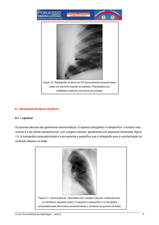Figura 10. Radiografia do tórax em PA demonstrando possível placa
(seta) em paciente exposto ao asbesto. Pseudoplaca por
metástase costal de carcinoma de próstata.

6 – Neoplasias benignas da pleura

6.1 – Lipomas

Os lipomas pleurais são geralmente assintomáticos. O aspecto radiográfico é inespecífico: o achado mais
comum é o de nódulo extrapulmonar, com margens obtusas, geralmente com pequenas dimensões (figura
11). A tomografia computadorizada é mais sensível e específica que a radiografia para a caracterização do
conteúdo adiposo na lesão.

Figura 11. Lipoma pleural. Opacidade com margens obtusas, extrapulmonar,
no hemitórax esquerdo (seta). O aspecto é inespecífico e a tomografia
computadorizada demonstrou posteriormente o conteúdo de gordura na lesão.
Curso PneumoAtual de Radiologia – aula 8

8

 