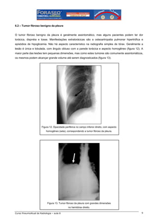 6.2 – Tumor fibroso benigno da pleura

O tumor fibroso benigno da pleura é geralmente assintomático, mas alguns pacientes podem ter dor
torácica, dispnéia e tosse. Manifestações extratorácicas são a osteoartropatia pulmonar hipertrófica e
episódios de hipoglicemia. Não há aspecto característico na radiografia simples de tórax. Geralmente a
lesão é única e lobulada, com ângulo obtuso com a parede torácica e aspecto homogêneo (figura 12). A
maior parte das lesões tem pequenas dimensões, mas como estes tumores são comumente assintomáticos,
os mesmos podem alcançar grande volume até serem diagnosticados (figura 13).

Figura 12. Opacidade periférica no campo inferior direito, com aspecto
homogêneo (seta), correspondendo a tumor fibroso da pleura.

Figura 13. Tumor fibroso da pleura com grandes dimensões
no hemitórax direito.
Curso PneumoAtual de Radiologia – aula 8

9

 