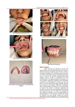 Priyesh Kesharwani et al; Saudi J Oral Dent Res, Jan 2020; 5(1): X
© 2020 |Published by Scholars Middle East Publishers, Dubai, United Arab Emirates 2
Fig-1: Mandibular implant placement
Fig-2: maxillary implant placement
Fig-3: Intaglio surface of the denture to accommodate the
housings
Fig-4-8: Overdenture is seated over the ball abutments
Fig-9: Removal of prosthesis
DISCUSSION
When restoring the edentulous maxilla with
dental implants, the most important decision to make is
whether the patient should be restored with a fixed or
removable prosthesis [18]. Problems arising from lack
of retention and stability among mandibular prosthetics
can be overcome by placing osseointegrated dental
implants, used to retain an overdenture [19]. The
transformation of an implant-supported overdenture to a
tissue implant- supported overdenture with a full palatal
coverage was recommended in a similar case like ours
[20]. It was also reported that higher bending moments
may develop on the implants supporting overdentures
than a fixed prosthesis. Therefore, it was recommended
to increase the number of implants supporting the
prosthesis in order to prevent the bending moments that
may cause bone loss [21, 22]. While it is accepted that
the 2-implant overdenture is not the gold standard of
implant therapy it is the minimum standard that should
be sufficient for most people, taking into account
performance, patient satisfaction, cost, and clinical time
 