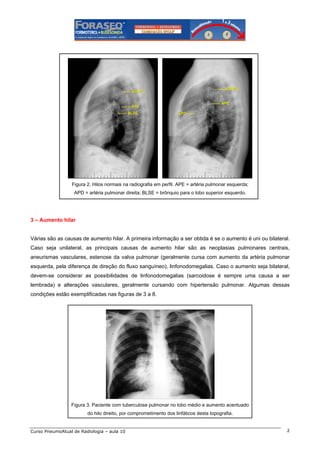 Figura 2. Hilos normais na radiografia em perfil. APE = artéria pulmonar esquerda;
APD = artéria pulmonar direita; BLSE = brônquio para o lobo superior esquerdo.

3 – Aumento hilar

Várias são as causas de aumento hilar. A primeira informação a ser obtida é se o aumento é uni ou bilateral.
Caso seja unilateral, as principais causas de aumento hilar são as neoplasias pulmonares centrais,
aneurismas vasculares, estenose da valva pulmonar (geralmente cursa com aumento da artéria pulmonar
esquerda, pela diferença de direção do fluxo sanguíneo), linfonodomegalias. Caso o aumento seja bilateral,
devem-se considerar as possibilidades de linfonodomegalias (sarcoidose é sempre uma causa a ser
lembrada) e alterações vasculares, geralmente cursando com hipertensão pulmonar. Algumas dessas
condições estão exemplificadas nas figuras de 3 a 8.

Figura 3. Paciente com tuberculose pulmonar no lobo médio e aumento acentuado
do hilo direito, por comprometimento dos linfáticos desta topografia.

Curso PneumoAtual de Radiologia – aula 10

2

 