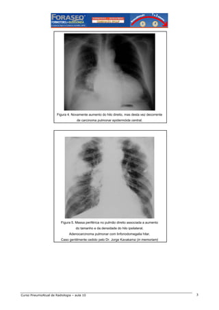 Figura 4. Novamente aumento do hilo direito, mas desta vez decorrente
de carcinoma pulmonar epidermóide central.

Figura 5. Massa periférica no pulmão direito associada a aumento
do tamanho e da densidade do hilo ipsilateral.
Adenocarcinoma pulmonar com linfonodomegalia hilar.
Caso gentilmente cedido pelo Dr. Jorge Kavakama (in memoriam)

Curso PneumoAtual de Radiologia – aula 10

3

 