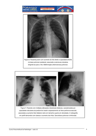 Figura 6. Paciente jovem com aumento do hilo direito e opacidade amorfa
na base pulmonar ipsilateral, associada a estruturas tubulares
dirigindo-se para o hilo. Malformação arteriovenosa pulmonar.

Figura 7. Paciente com múltiplas alterações intersticiais bilaterais, caracterizadas por
opacidades reticulares de predomínio basal e espessamento do feixe peribroncovascular,
associadas a aumento hilar bilateral, tanto em tamanho quanto em densidade. A radiografia
em perfil demonstra com clareza o aumento dos hilos. Sarcoidose pulmonar e linfonodal.

Curso PneumoAtual de Radiologia – aula 10

4

 