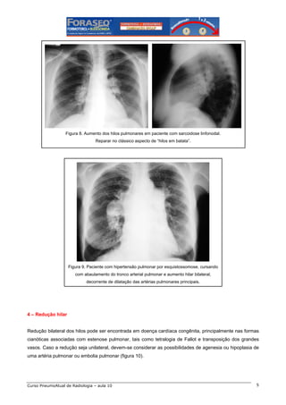Figura 8. Aumento dos hilos pulmonares em paciente com sarcoidose linfonodal.
Reparar no clássico aspecto de “hilos em batata”.

Figura 9. Paciente com hipertensão pulmonar por esquistossomose, cursando
com abaulamento do tronco arterial pulmonar e aumento hilar bilateral,
decorrente de dilatação das artérias pulmonares principais.

4 – Redução hilar

Redução bilateral dos hilos pode ser encontrada em doença cardíaca congênita, principalmente nas formas
cianóticas associadas com estenose pulmonar, tais como tetralogia de Fallot e transposição dos grandes
vasos. Caso a redução seja unilateral, devem-se considerar as possibilidades de agenesia ou hipoplasia de
uma artéria pulmonar ou embolia pulmonar (figura 10).

Curso PneumoAtual de Radiologia – aula 10

5

 