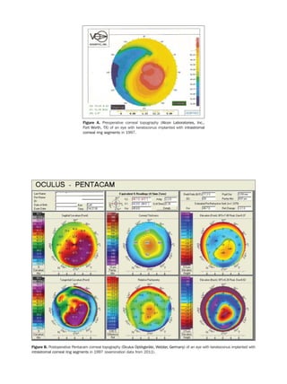 Figure B. Postoperative Pentacam corneal topography (Oculus Optikgeräte, Wetzlar, Germany) of an eye with keratoconus implanted with
intrastromal corneal ring segments in 1997 (examination data from 2011).
Figure A. Preoperative corneal topography (Alcon Laboratories, Inc.,
Fort Worth, TX) of an eye with keratoconus implanted with intrastromal
corneal ring segments in 1997.
 