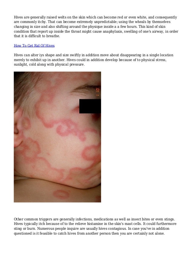 Options Pertaining To Allieviating Papular Urticaria