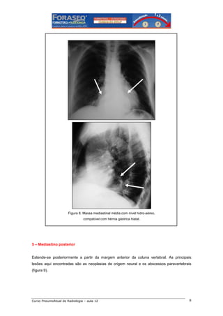 Figura 8. Massa mediastinal média com nível hidro-aéreo,
compatível com hérnia gástrica hiatal.

5 – Mediastino posterior

Estende-se posteriormente a partir da margem anterior da coluna vertebral. As principais
lesões aqui encontradas são as neoplasias de origem neural e os abscessos paravertebrais
(figura 9).

Curso PneumoAtual de Radiologia – aula 12

8

 