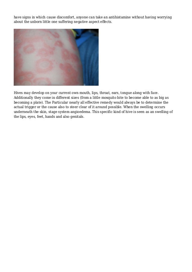 The Best Method To Treat Ones Urticaria Hives Is To Determine What May