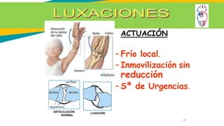ACTUACIÓN
– Frío local.
– Inmovilización sin
reducción
– Sº de Urgencias.
ARTICULACIÓN
NORMAL
LUXACIÓN
16
 