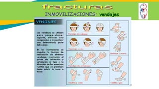 INMOVILIZACIONES: vendajes
25
 