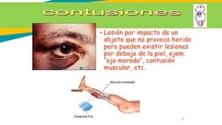 73
• Lesión por impacto de un
objeto que no provoca herida
pero pueden existir lesiones
por debajo de la piel, ejem.
“ojo morado”, contusión
muscular, etc.
 