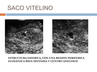 SACO VITELINO
ESTRUCTURA ESFERICA, CON UNA REGION PERIFERICA
ECOGENICA BIEN DEFINIDA Y CENTRO ANECOICO
 