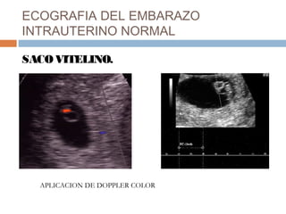ECOGRAFIA DEL EMBARAZO
INTRAUTERINO NORMAL
SACO VITELINO.
APLICACION DE DOPPLER COLOR
 