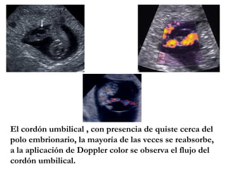 El cordón umbilical , con presencia de quiste cerca del
polo embrionario, la mayoría de las veces se reabsorbe,
a la aplicación de Doppler color se observa el flujo del
cordón umbilical.
 