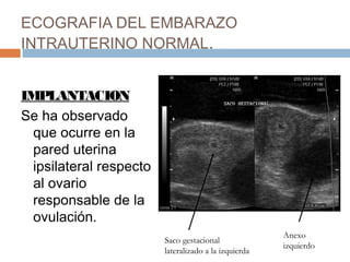 ECOGRAFIA DEL EMBARAZO
INTRAUTERINO NORMAL.
IMPLANTACION
Se ha observado
que ocurre en la
pared uterina
ipsilateral respecto
al ovario
responsable de la
ovulación.
Anexo
izquierdo
Saco gestacional
lateralizado a la izquierda
 