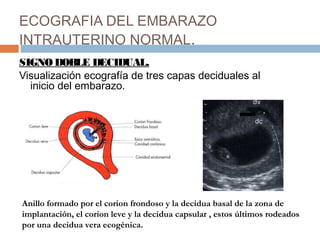 ECOGRAFIA DEL EMBARAZO
INTRAUTERINO NORMAL.
SIGNODOBLE DECIDUAL.
Visualización ecografía de tres capas deciduales al
inicio del embarazo.
Anillo formado por el corion frondoso y la decidua basal de la zona de
implantación, el corion leve y la decidua capsular , estos últimos rodeados
por una decidua vera ecogénica.
 
