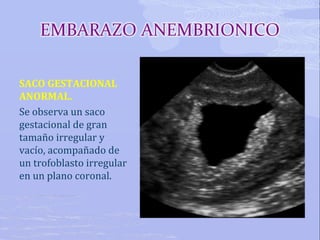 Embarazo Anembri nico PPT