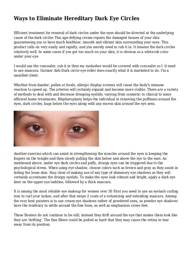 hereditary dark circles remedies