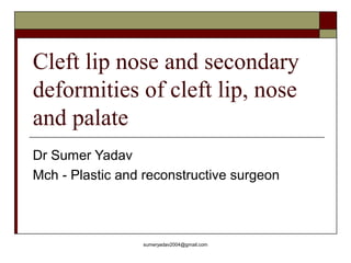 Cleft lip nose and secondary
deformities of cleft lip, nose
and palate
Dr Sumer Yadav
Mch - Plastic and reconstructive surgeon
sumeryadav2004@gmail.com
 
