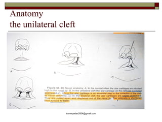 secondary deformities of cleft LIP AND NOSE | PPT